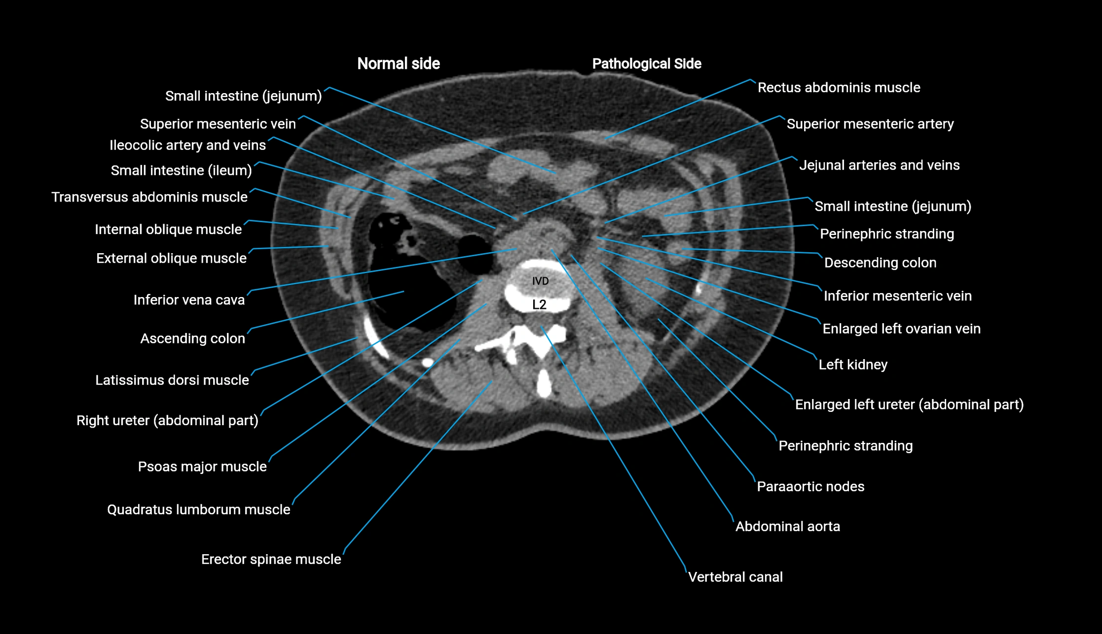 CT KUB axial cross sectional anatomy  radiology image -img-00201-00062.webp